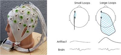 Interictal Epileptiform Discharge Dynamics in Peri-sylvian Polymicrogyria Using EEG-fMRI